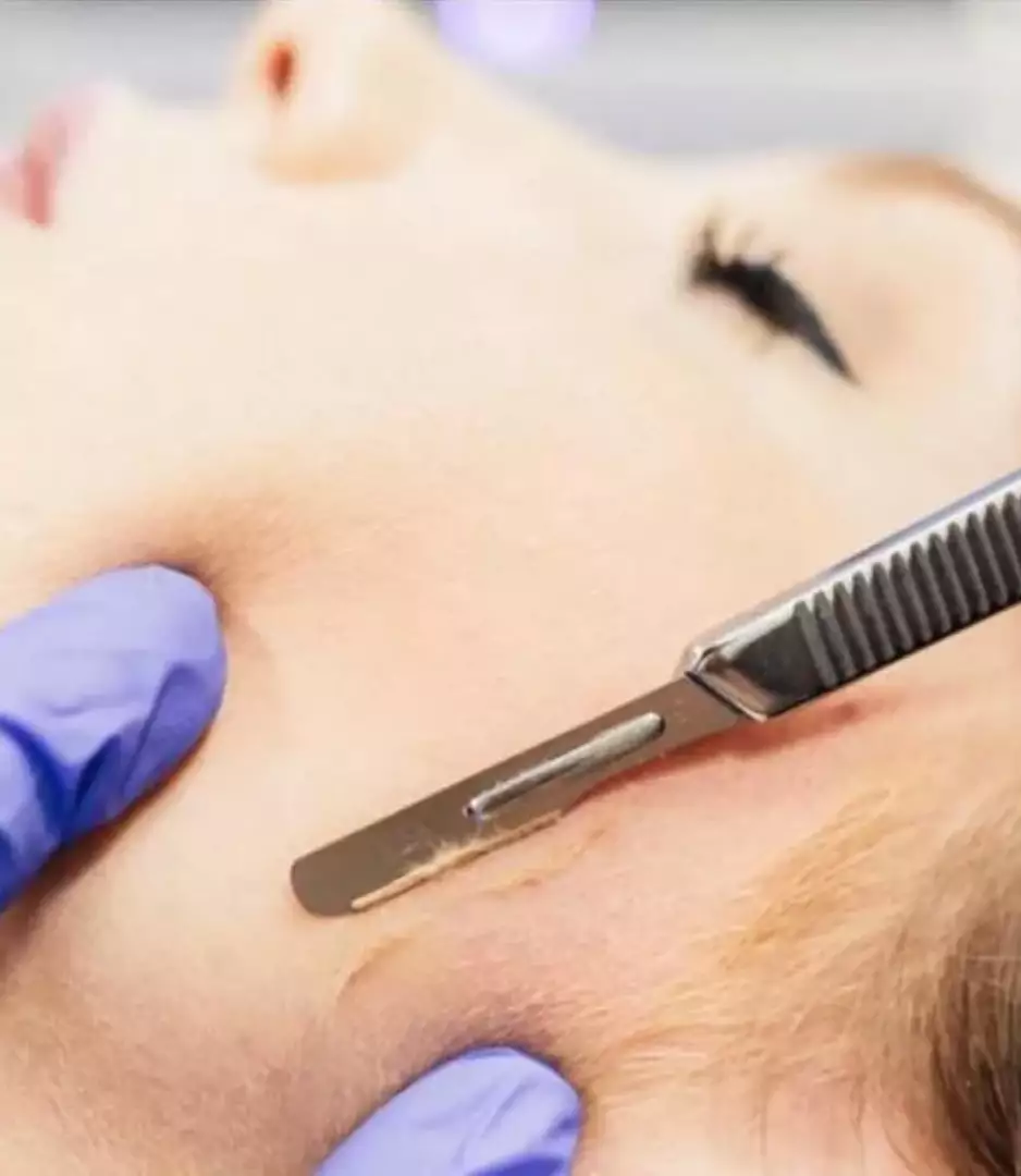dermaplaning-huidverbetering-gezichtsverzorging-Mani-E-Piedi-Nieuwpoort-Schoonheidsinstituut-huidverbetering -  - Dermaplaning