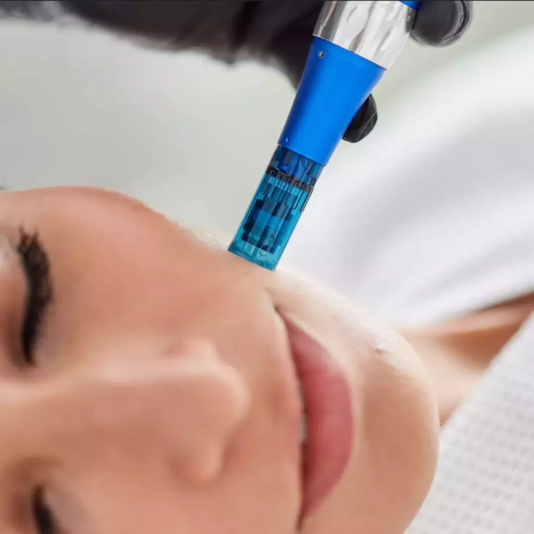 microneedling-huidverbetering-gezichtsverzorging-Mani-E-Piedi-Nieuwpoort-Schoonheidsinstituut-huidverbetering